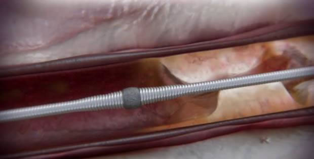 Orbital atherectomy