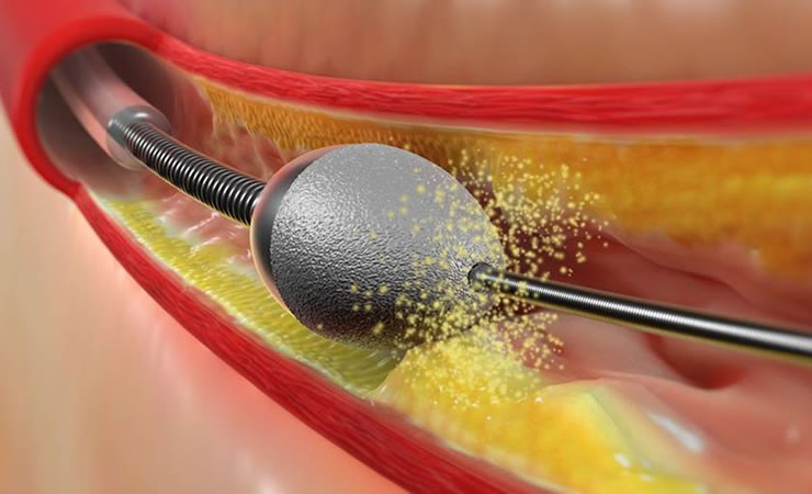 Rotational atherectomy