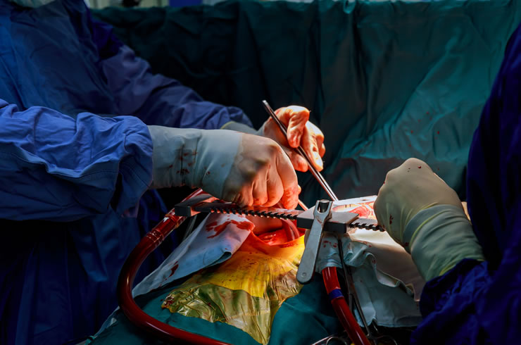 cabg bypass (1)