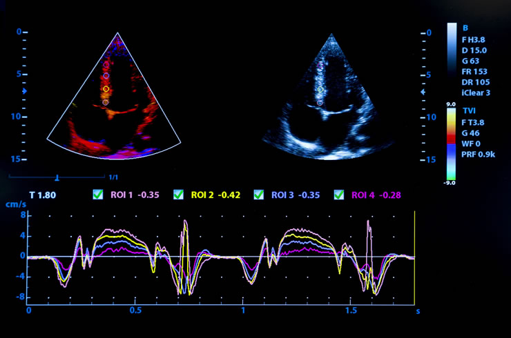cardiac echo (1)
