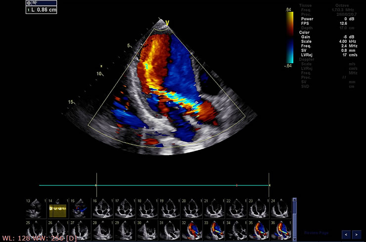 cardiac echo (2)