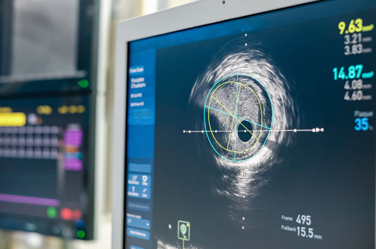 ivus (1)